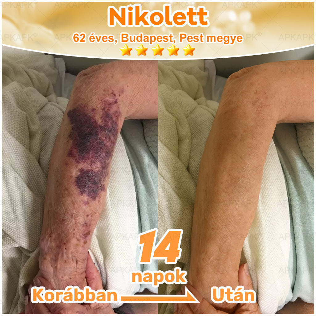 ⭐APKAPK®  Méhméreg krém a bőr megújítására 🐝 segít megoldani olyan bőrproblémákat, mint: ráncok, hegek, pigmentfoltok, striák, akné, pikkelysömör, ekcéma, bőrelváltozások, irritációk, gyulladások és egyéb bőrpanaszok.