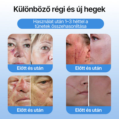 FFBSI® 🧊CoolErase Bőrregeneráló Spray (Szemölcsök, Hólyagok, Ekcéma, Pikkelysömör, Bőrkinövések, Akne, Bőrcímkék, Hegek, Anyajegyek)