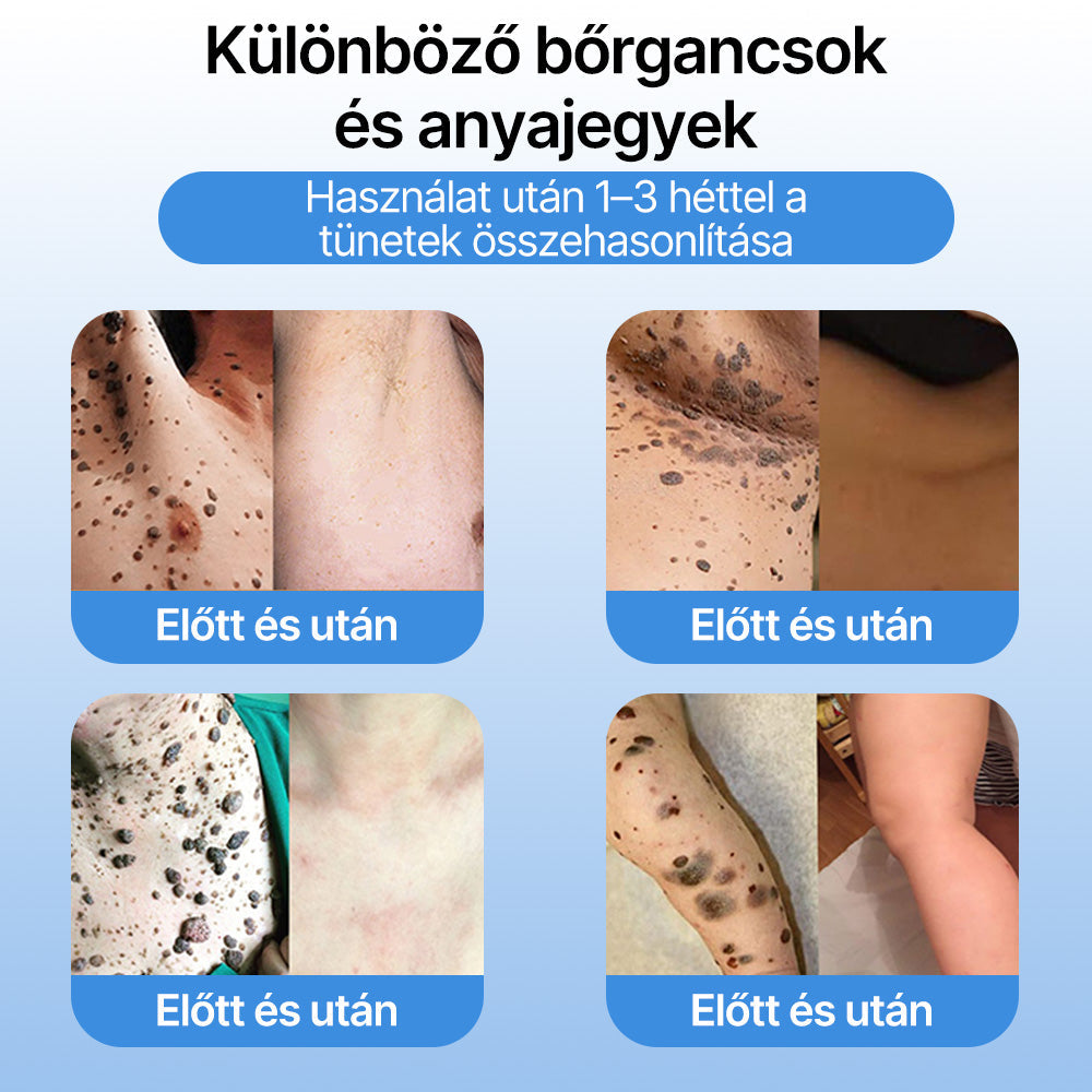 FFBSI® 🧊CoolErase Bőrregeneráló Spray (Szemölcsök, Hólyagok, Ekcéma, Pikkelysömör, Bőrkinövések, Akne, Bőrcímkék, Hegek, Anyajegyek)