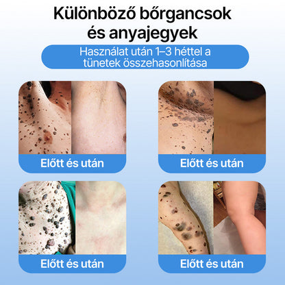 FFBSI® 🧊CoolErase Bőrregeneráló Spray (Szemölcsök, Hólyagok, Ekcéma, Pikkelysömör, Bőrkinövések, Akne, Bőrcímkék, Hegek, Anyajegyek)