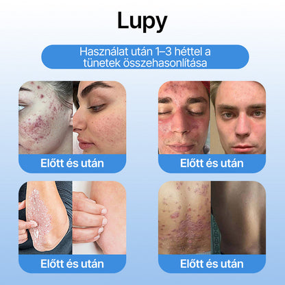 FFBSI® 🧊CoolErase Bőrregeneráló Spray (Szemölcsök, Hólyagok, Ekcéma, Pikkelysömör, Bőrkinövések, Akne, Bőrcímkék, Hegek, Anyajegyek)