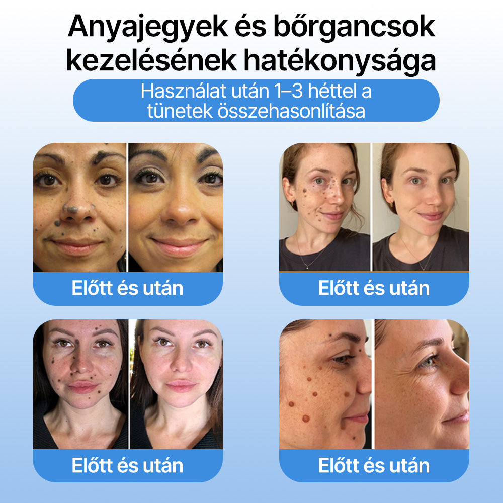 FFBSI® 🧊CoolErase Bőrregeneráló Spray (Szemölcsök, Hólyagok, Ekcéma, Pikkelysömör, Bőrkinövések, Akne, Bőrcímkék, Hegek, Anyajegyek)