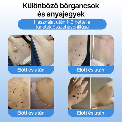 FFBSI® 🧊CoolErase Bőrregeneráló Spray (Szemölcsök, Hólyagok, Ekcéma, Pikkelysömör, Bőrkinövések, Akne, Bőrcímkék, Hegek, Anyajegyek)