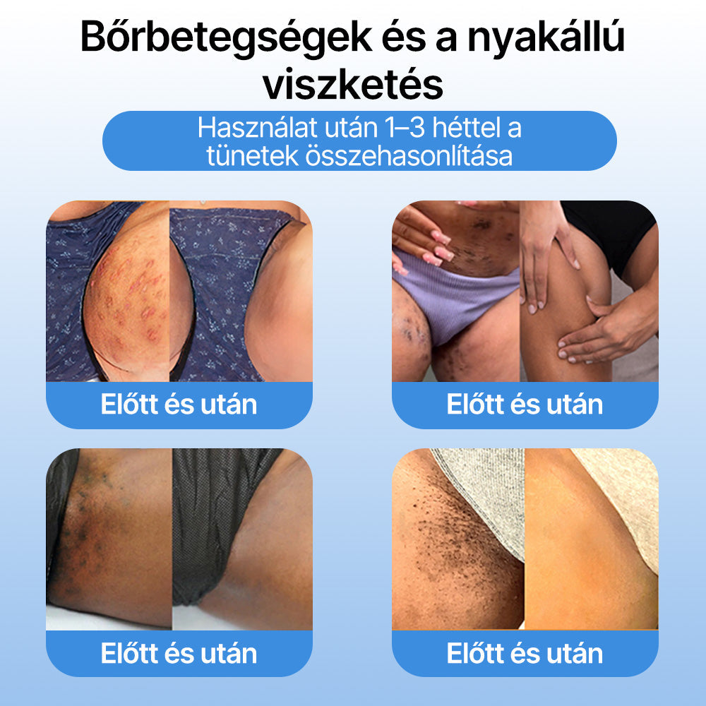 FFBSI® 🧊CoolErase Bőrregeneráló Spray (Szemölcsök, Hólyagok, Ekcéma, Pikkelysömör, Bőrkinövések, Akne, Bőrcímkék, Hegek, Anyajegyek)