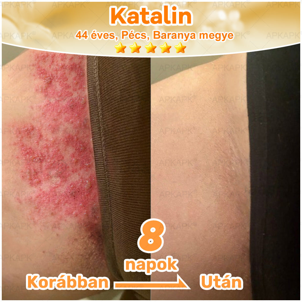 ⭐APKAPK®  Méhméreg krém a bőr megújítására 🐝 segít megoldani olyan bőrproblémákat, mint: ráncok, hegek, pigmentfoltok, striák, akné, pikkelysömör, ekcéma, bőrelváltozások, irritációk, gyulladások és egyéb bőrpanaszok.