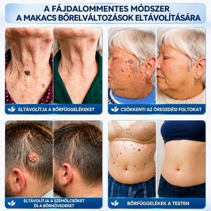 𝐇𝐈𝐒𝐊𝐈𝐍® 𝟕 𝐧𝐚𝐩𝐨𝐬 𝐤𝐫é𝐦 𝐛ő𝐫𝐤𝐢𝐧ö𝐯é𝐬𝐞𝐤 𝐞́𝐬 𝐩𝐢𝐠𝐦𝐞𝐧𝐭𝐟𝐨𝐥𝐭𝐨𝐤 𝐞𝐥𝐥𝐞𝐧 (𝐅á𝐣𝐝𝐚𝐥𝐨𝐦𝐦𝐞𝐧𝐭𝐞𝐬 𝐟𝐨𝐫𝐦𝐮𝐥𝐚 – 𝐇𝐞𝐠𝐦𝐞𝐧𝐭𝐞𝐬)