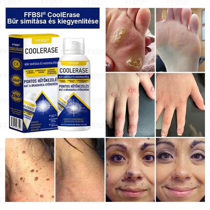 FFBSI® 🧊CoolErase Bőrregeneráló Spray (Szemölcsök, Hólyagok, Ekcéma, Pikkelysömör, Bőrkinövések, Akne, Bőrcímkék, Hegek, Anyajegyek)