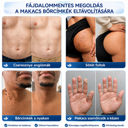 𝐇𝐈𝐒𝐊𝐈𝐍® 𝟕 𝐧𝐚𝐩𝐨𝐬 𝐤𝐫é𝐦 𝐛ő𝐫𝐤𝐢𝐧ö𝐯é𝐬𝐞𝐤 𝐞́𝐬 𝐩𝐢𝐠𝐦𝐞𝐧𝐭𝐟𝐨𝐥𝐭𝐨𝐤 𝐞𝐥𝐥𝐞𝐧 (𝐅á𝐣𝐝𝐚𝐥𝐨𝐦𝐦𝐞𝐧𝐭𝐞𝐬 𝐟𝐨𝐫𝐦𝐮𝐥𝐚 – 𝐇𝐞𝐠𝐦𝐞𝐧𝐭𝐞𝐬)