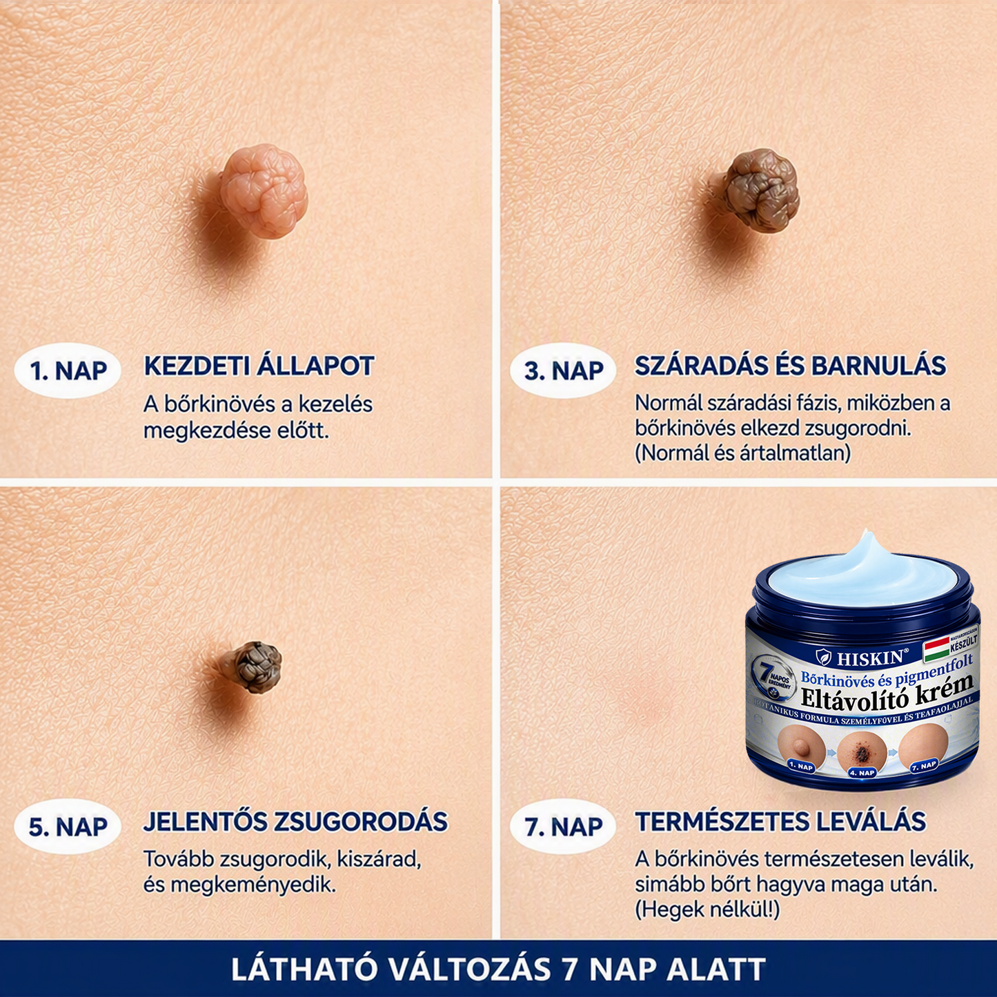 𝐇𝐈𝐒𝐊𝐈𝐍® 𝟕 𝐧𝐚𝐩𝐨𝐬 𝐤𝐫é𝐦 𝐛ő𝐫𝐤𝐢𝐧ö𝐯é𝐬𝐞𝐤 𝐞́𝐬 𝐩𝐢𝐠𝐦𝐞𝐧𝐭𝐟𝐨𝐥𝐭𝐨𝐤 𝐞𝐥𝐥𝐞𝐧 (𝐅á𝐣𝐝𝐚𝐥𝐨𝐦𝐦𝐞𝐧𝐭𝐞𝐬 𝐟𝐨𝐫𝐦𝐮𝐥𝐚 – 𝐇𝐞𝐠𝐦𝐞𝐧𝐭𝐞𝐬)